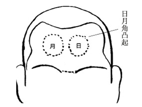 额头凹凸不平面相图解(图2)